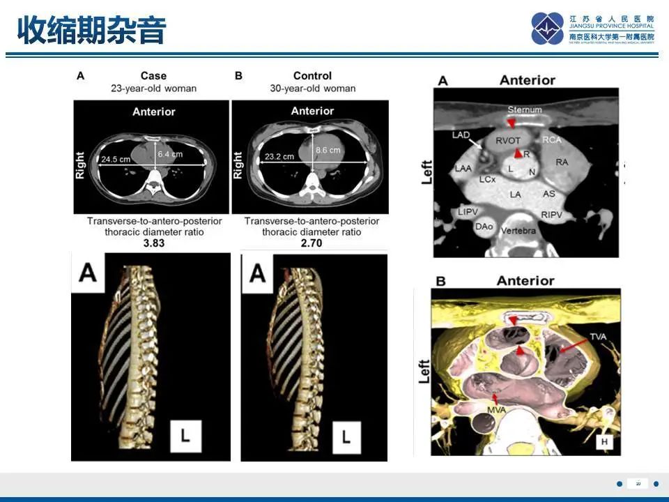 【PPT】直背综合征-21
