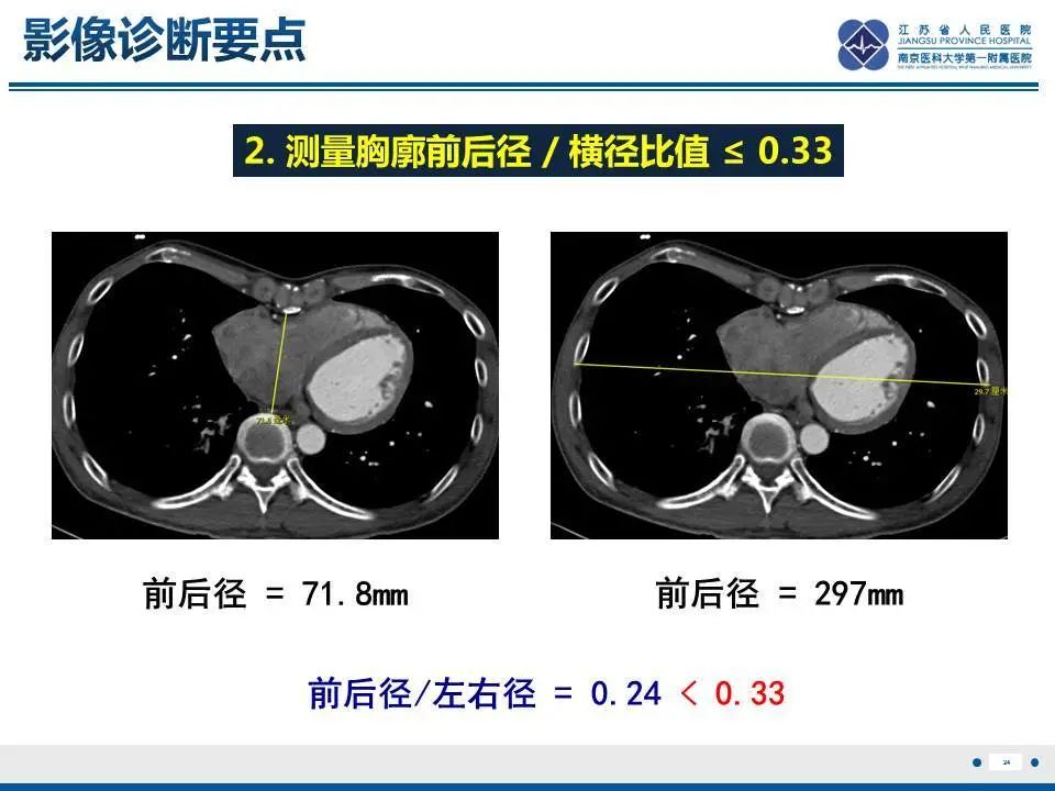 【PPT】直背综合征-25