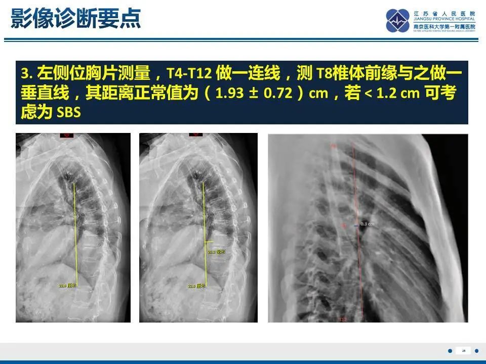 【PPT】直背综合征-26