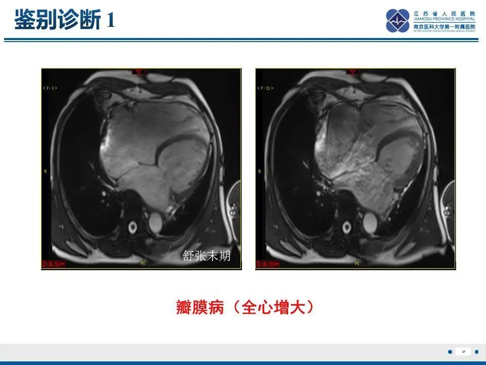 【PPT】直背综合征-28
