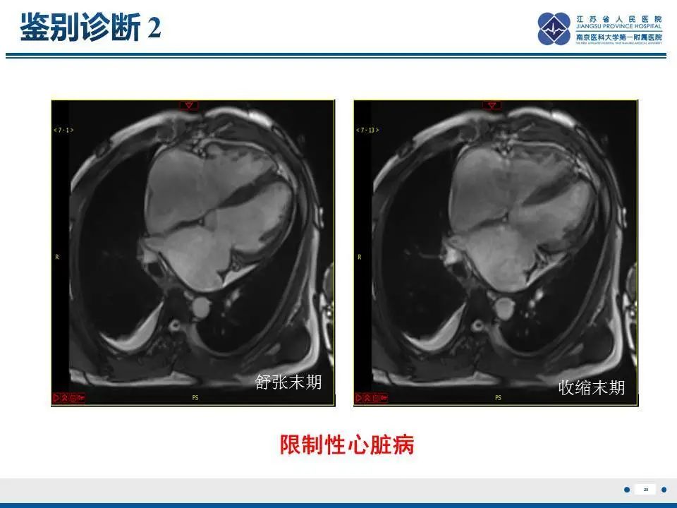 【PPT】直背综合征-30