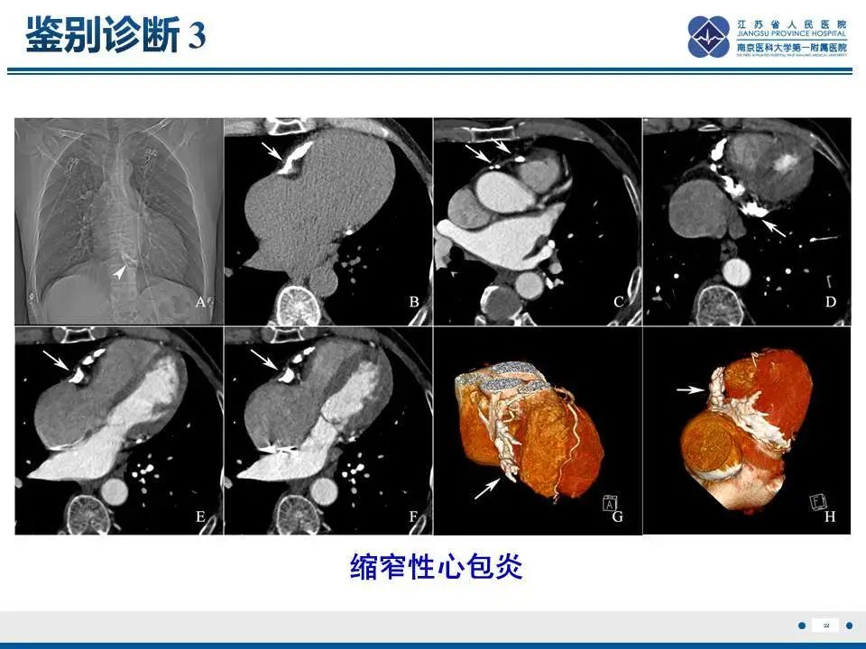 【PPT】直背综合征-33