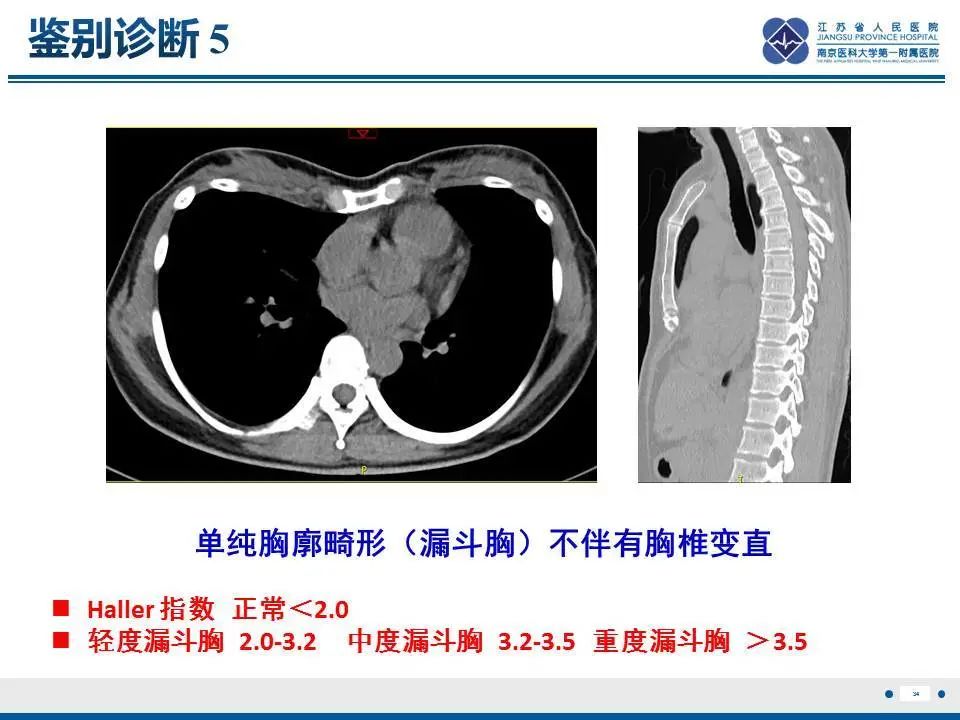 【PPT】直背综合征-35
