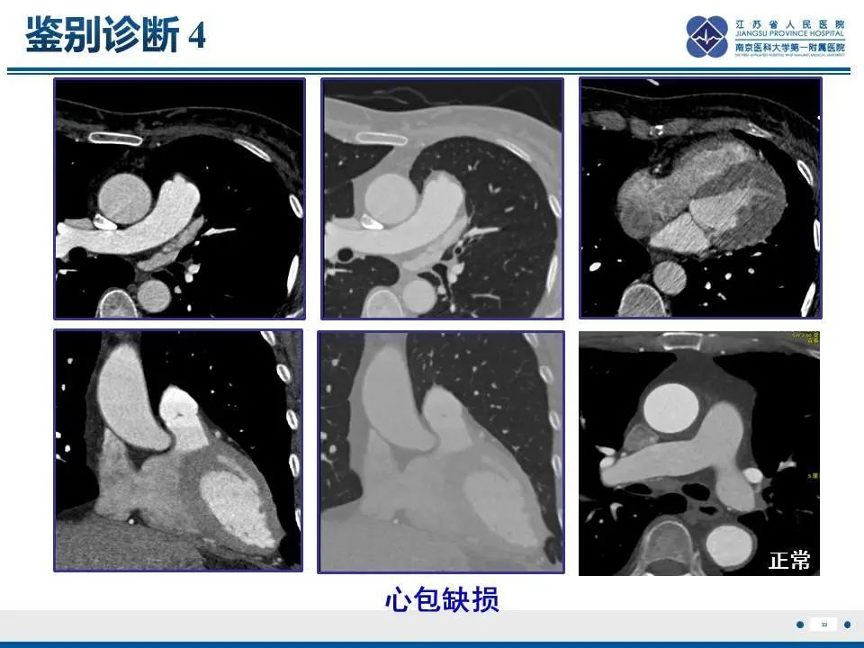 【PPT】直背综合征-34