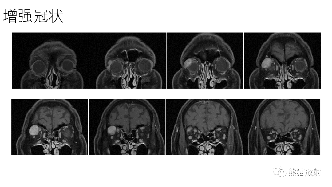 【PPT】泪腺多形性腺瘤 VS 眼眶淋巴瘤-5