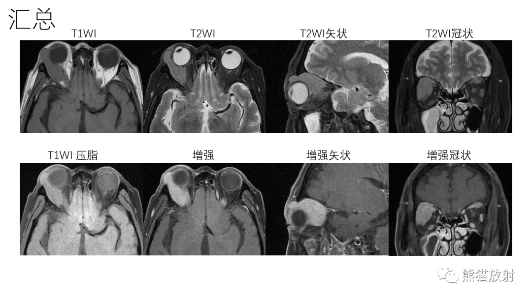 【PPT】泪腺多形性腺瘤 VS 眼眶淋巴瘤-8