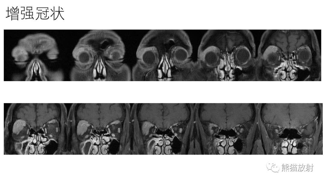 【PPT】泪腺多形性腺瘤 VS 眼眶淋巴瘤-10
