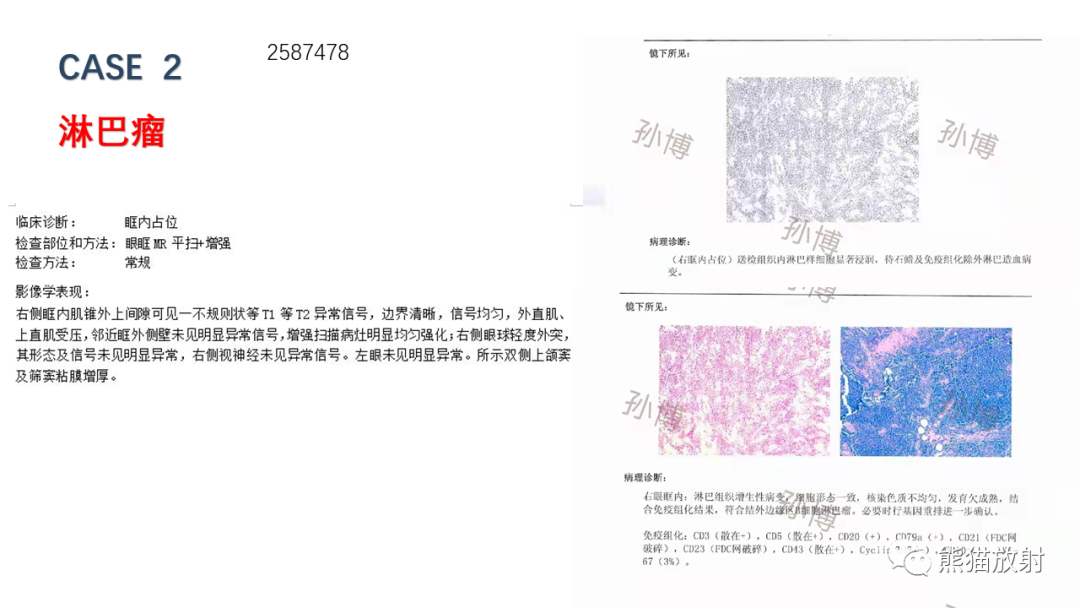 【PPT】泪腺多形性腺瘤 VS 眼眶淋巴瘤-13