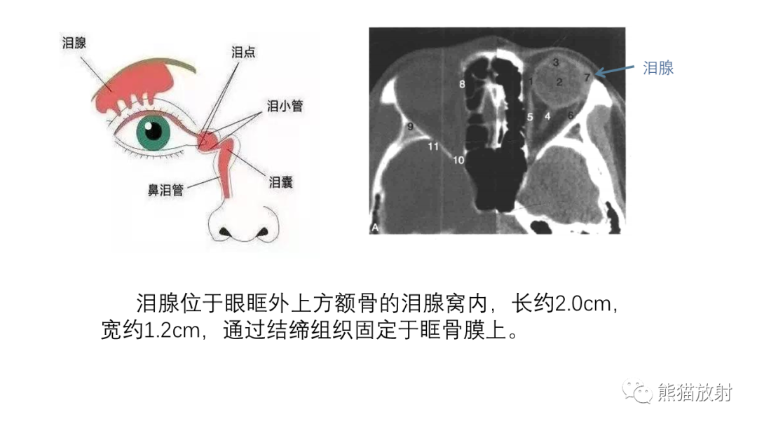 【PPT】泪腺多形性腺瘤 VS 眼眶淋巴瘤-15