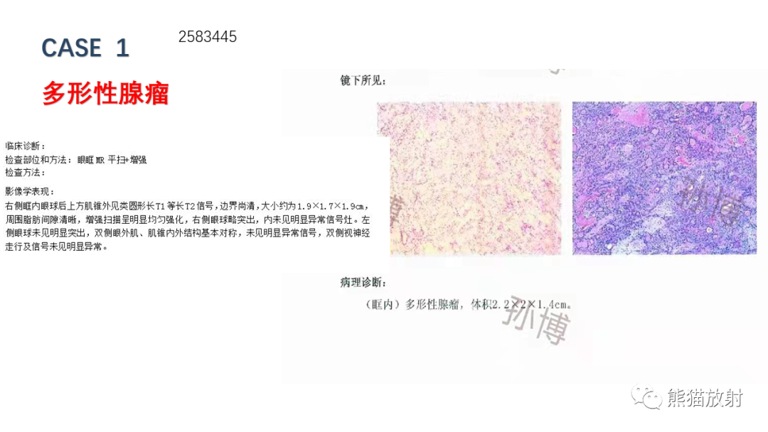【PPT】泪腺多形性腺瘤 VS 眼眶淋巴瘤-12