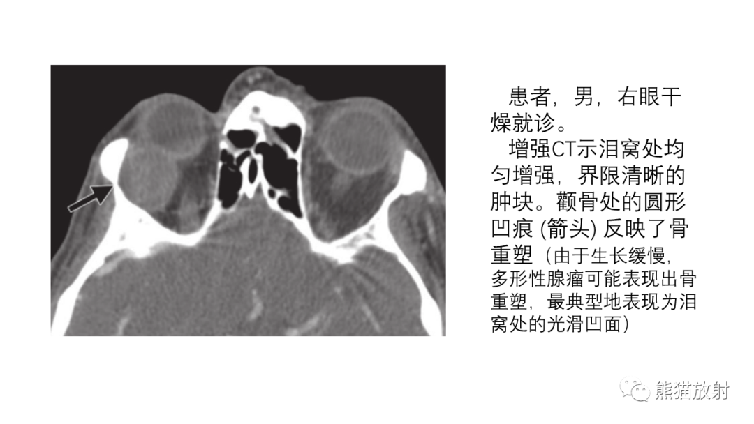 【PPT】泪腺多形性腺瘤 VS 眼眶淋巴瘤-21
