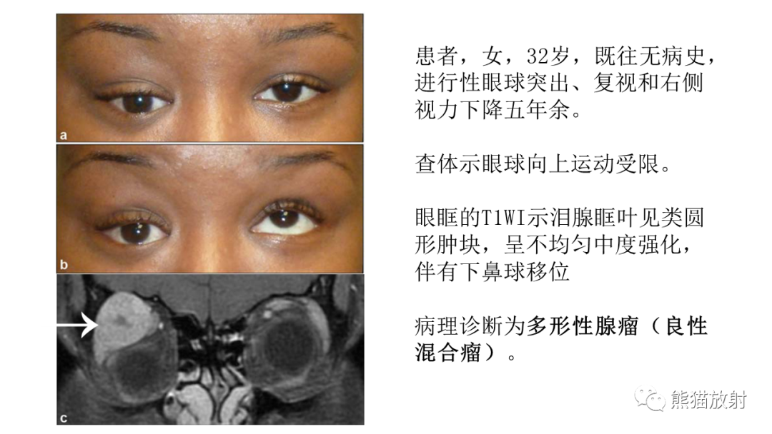 【PPT】泪腺多形性腺瘤 VS 眼眶淋巴瘤-22