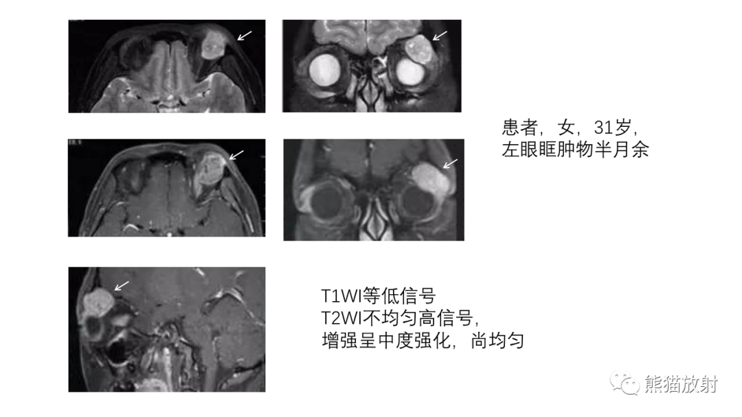 【PPT】泪腺多形性腺瘤 VS 眼眶淋巴瘤-23