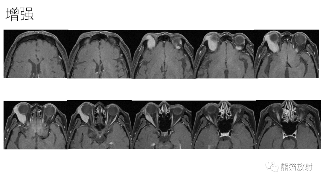 【PPT】泪腺多形性腺瘤 VS 眼眶淋巴瘤-9