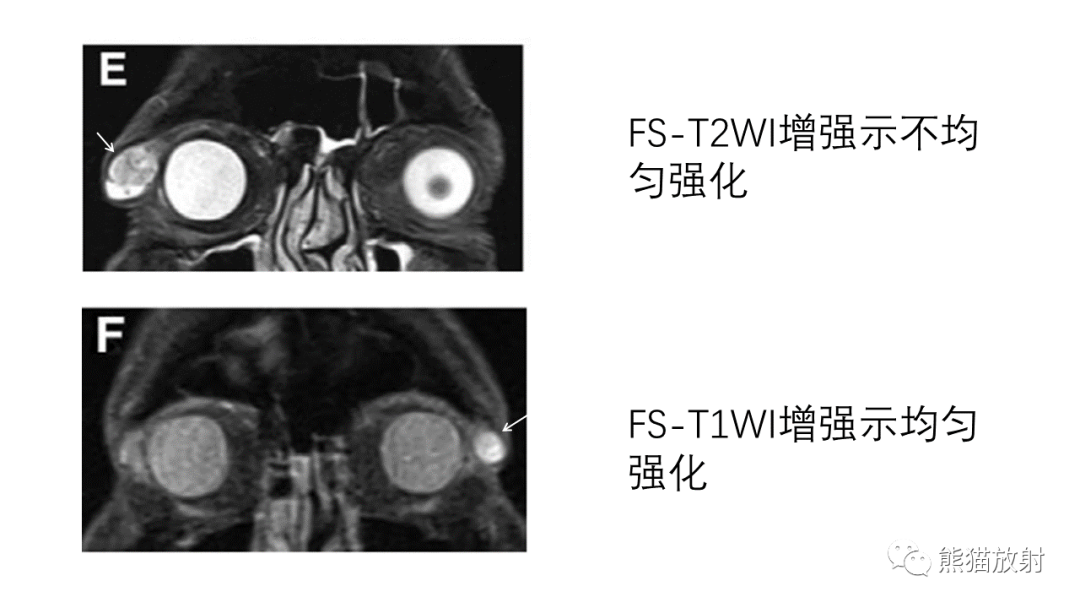 【PPT】泪腺多形性腺瘤 VS 眼眶淋巴瘤-24