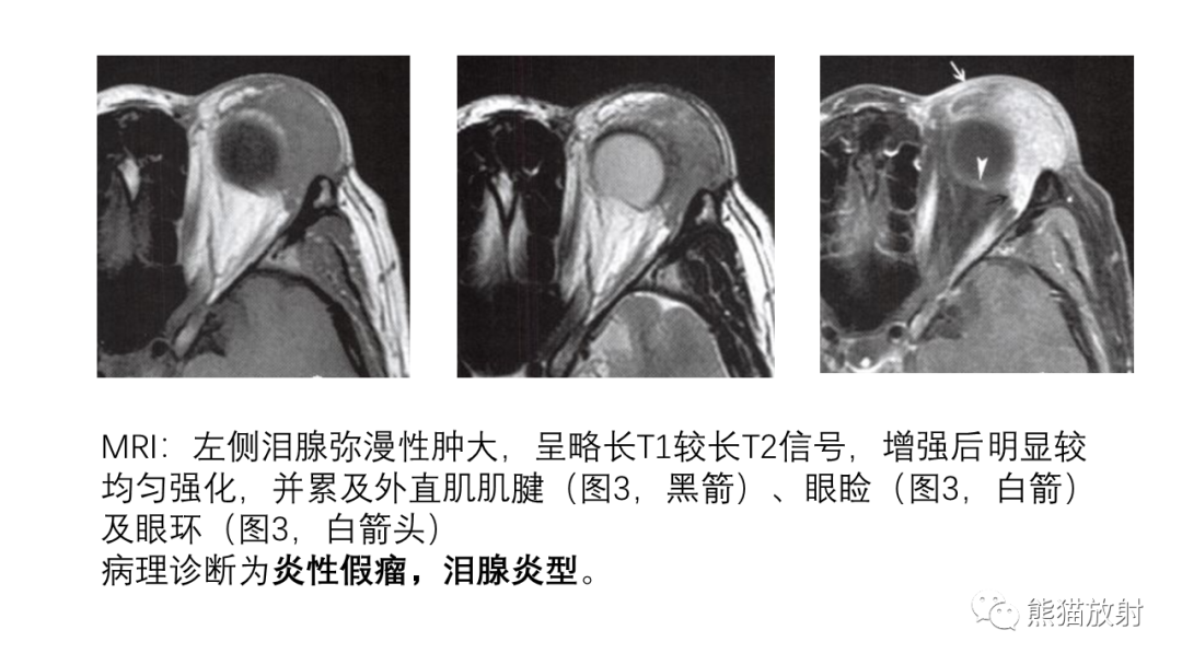 【PPT】泪腺多形性腺瘤 VS 眼眶淋巴瘤-28