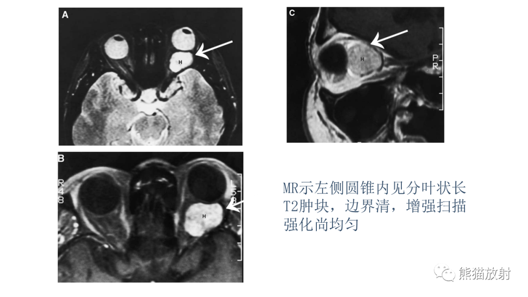 【PPT】泪腺多形性腺瘤 VS 眼眶淋巴瘤-30