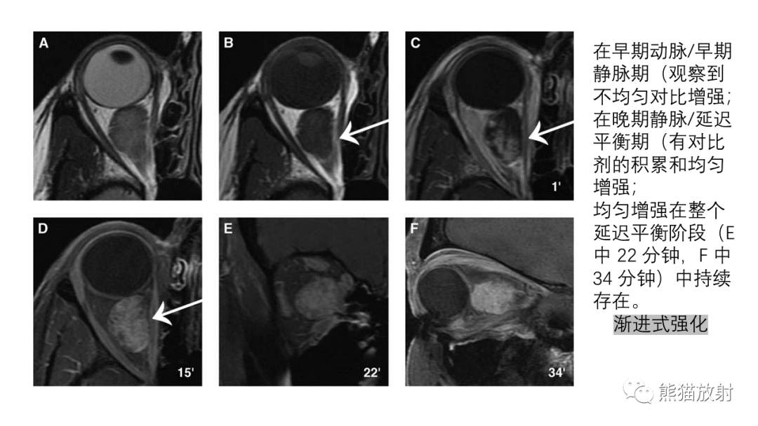 【PPT】泪腺多形性腺瘤 VS 眼眶淋巴瘤-31