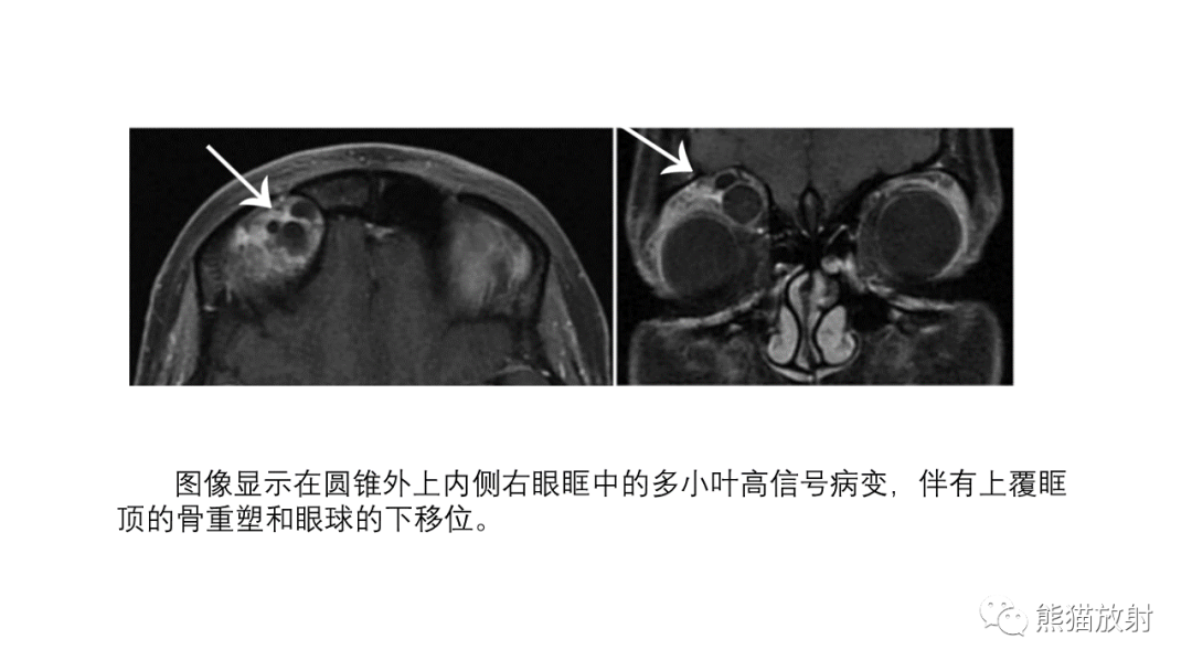 【PPT】泪腺多形性腺瘤 VS 眼眶淋巴瘤-33