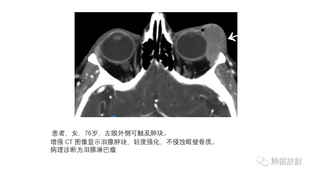 【PPT】泪腺多形性腺瘤 VS 眼眶淋巴瘤-35