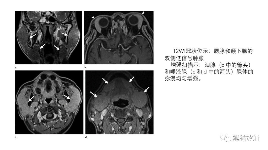 【PPT】泪腺多形性腺瘤 VS 眼眶淋巴瘤-37