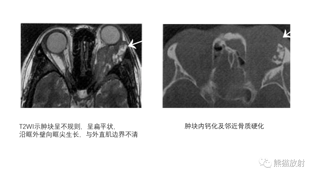 【PPT】泪腺多形性腺瘤 VS 眼眶淋巴瘤-39