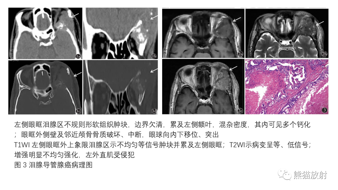 【PPT】泪腺多形性腺瘤 VS 眼眶淋巴瘤-41