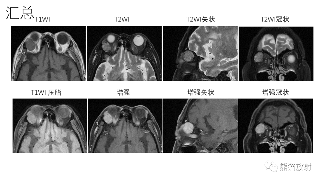 【PPT】泪腺多形性腺瘤 VS 眼眶淋巴瘤-2