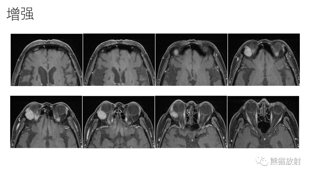 【PPT】泪腺多形性腺瘤 VS 眼眶淋巴瘤-3