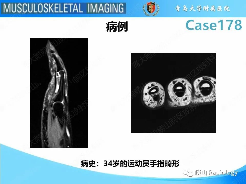 【PPT】手指滑车损伤-2