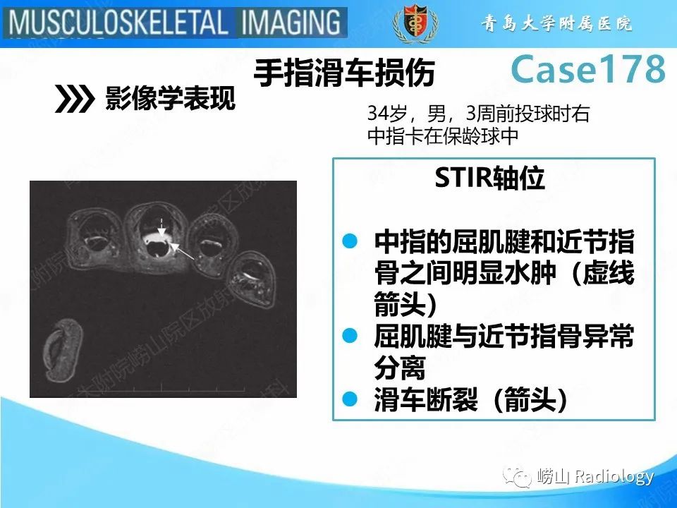 【PPT】手指滑车损伤-16