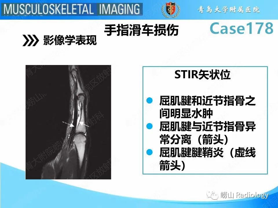 【PPT】手指滑车损伤-17