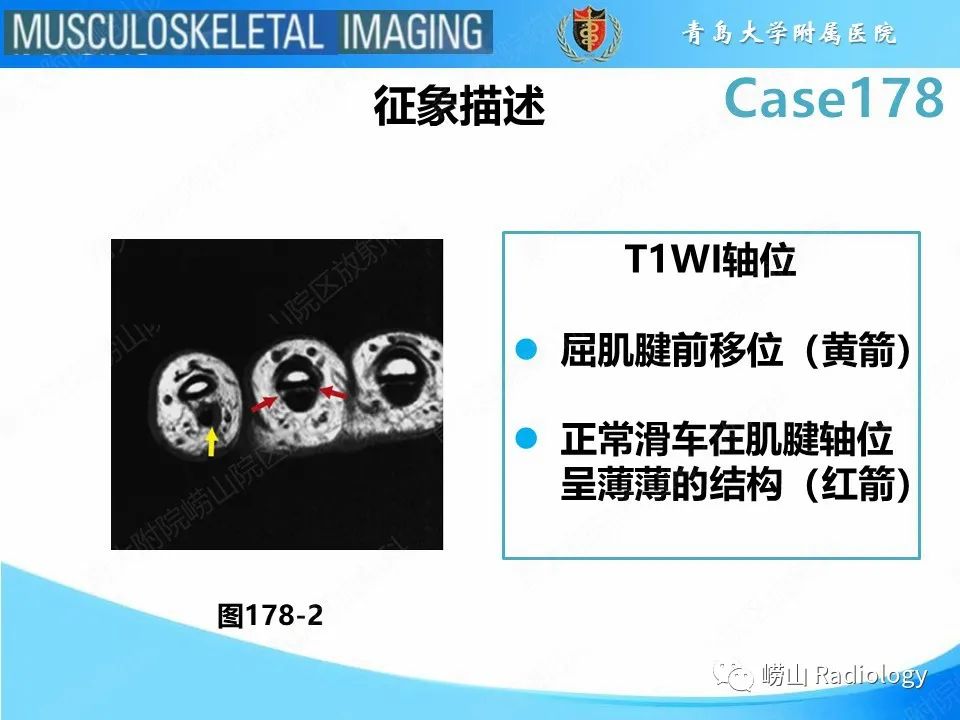 【PPT】手指滑车损伤-19