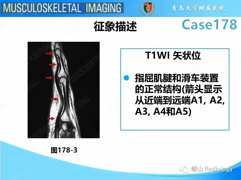 【PPT】手指滑车损伤-20