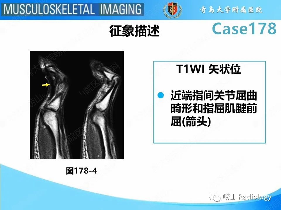 【PPT】手指滑车损伤-21