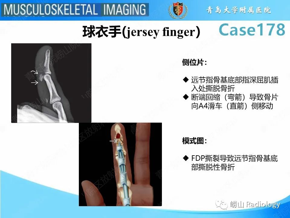 【PPT】手指滑车损伤-23