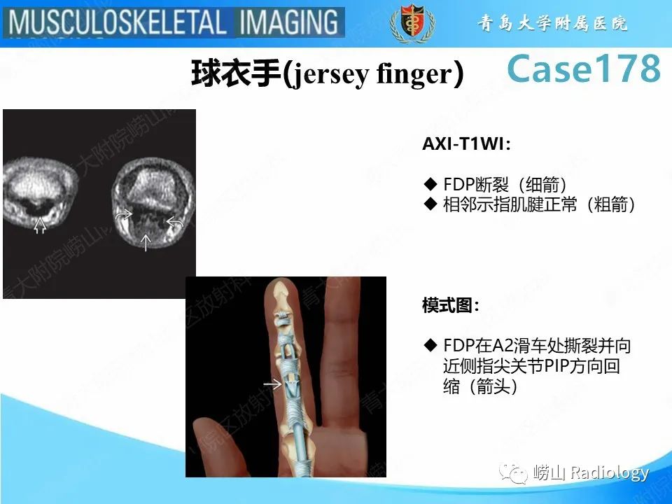 【PPT】手指滑车损伤-24