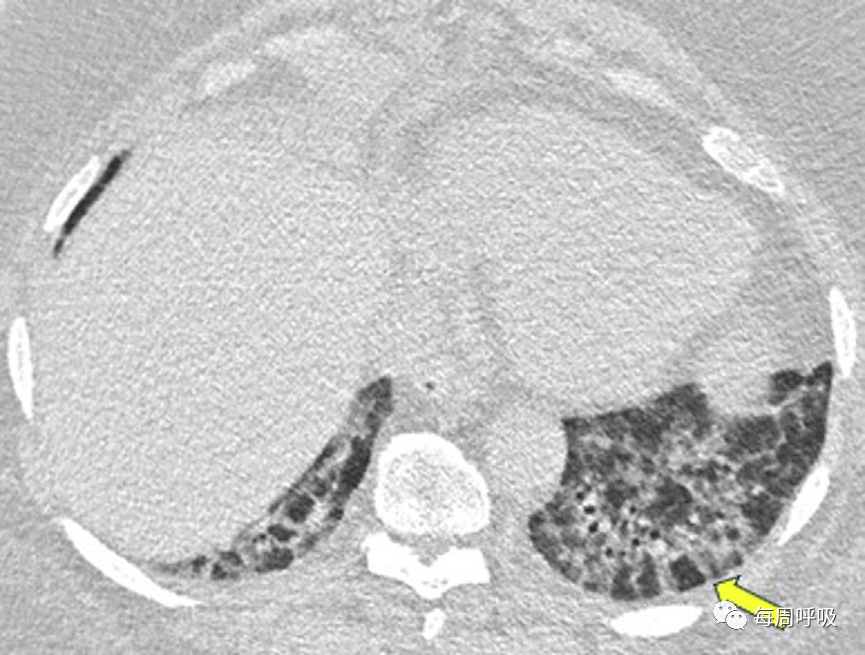 机化性肺炎的诊断流程(临床-影像-病理特征相关性)-21 机化性肺炎的诊断流程(临床-影像-病理特征相关性)-21