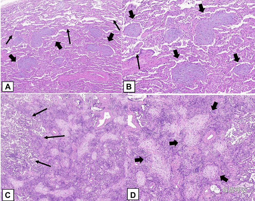 机化性肺炎的诊断流程(临床-影像-病理特征相关性)-23 机化性肺炎的诊断流程(临床-影像-病理特征相关性)-23