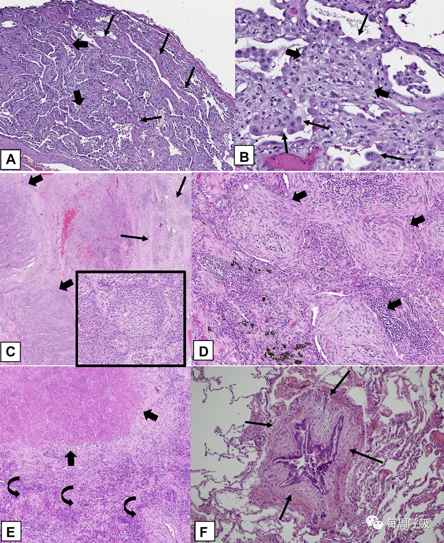 机化性肺炎的诊断流程(临床-影像-病理特征相关性)-28 机化性肺炎的诊断流程(临床-影像-病理特征相关性)-28