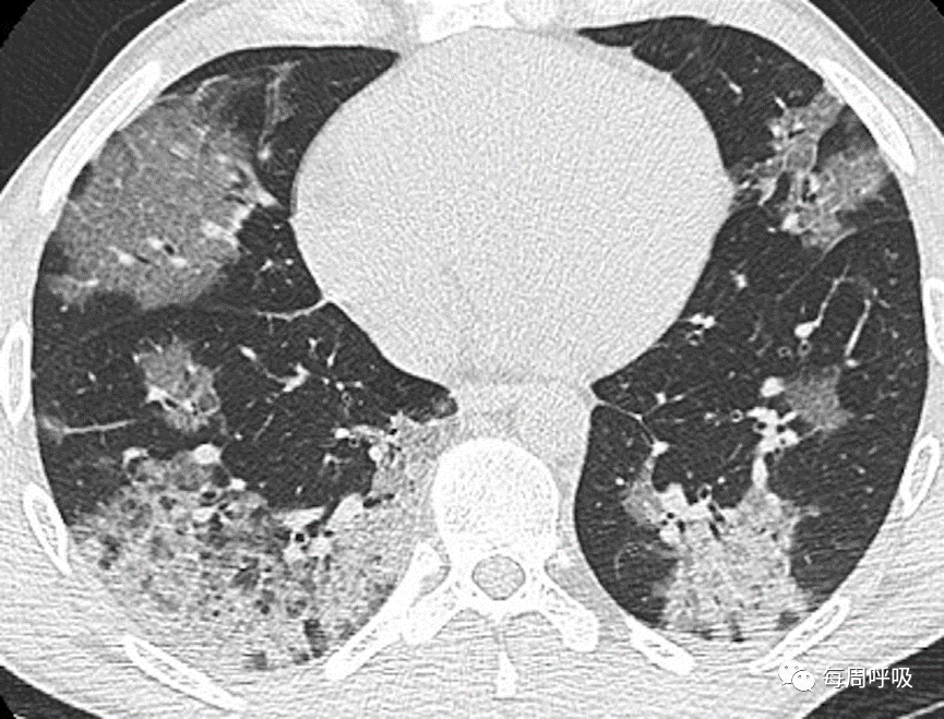 机化性肺炎的诊断流程(临床-影像-病理特征相关性)-31 机化性肺炎的诊断流程(临床-影像-病理特征相关性)-31