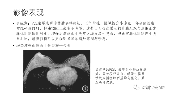 【PPT】浆细胞性乳腺炎的MRI诊断-4