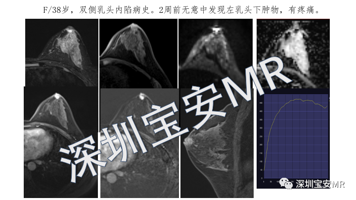【PPT】浆细胞性乳腺炎的MRI诊断-5