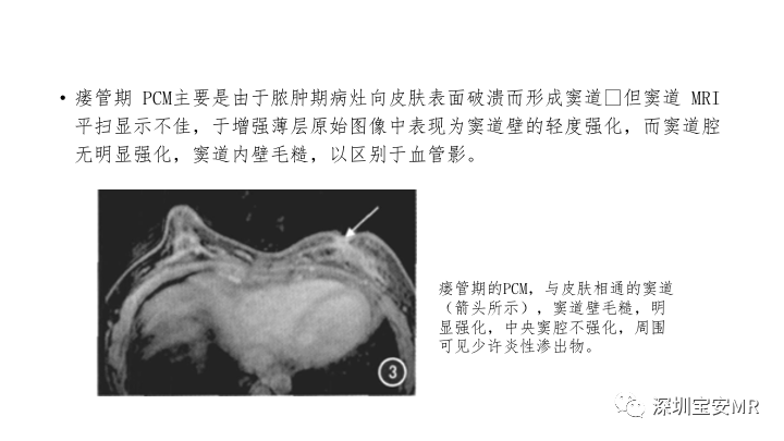 【PPT】浆细胞性乳腺炎的MRI诊断-10