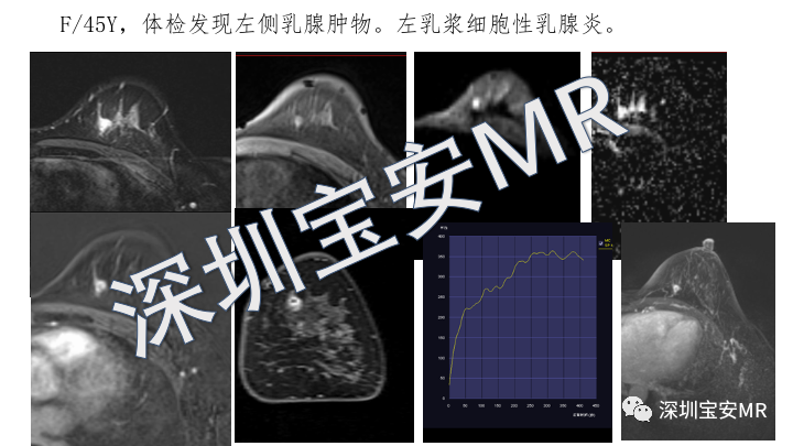 【PPT】浆细胞性乳腺炎的MRI诊断-8