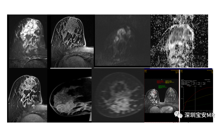 【PPT】浆细胞性乳腺炎的MRI诊断-9