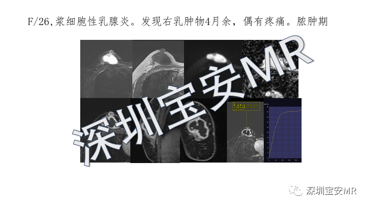 【PPT】浆细胞性乳腺炎的MRI诊断-7