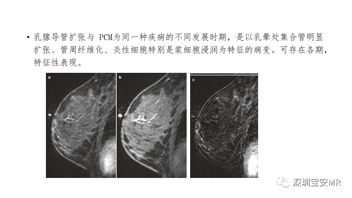 【PPT】浆细胞性乳腺炎的MRI诊断-11