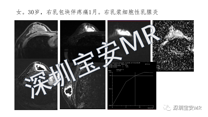【PPT】浆细胞性乳腺炎的MRI诊断-12