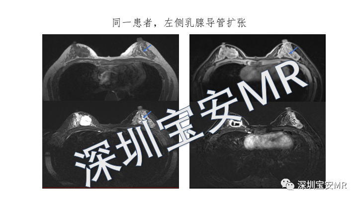 【PPT】浆细胞性乳腺炎的MRI诊断-13